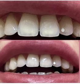 11 причин «прозрачности зубов» и 1 решение.