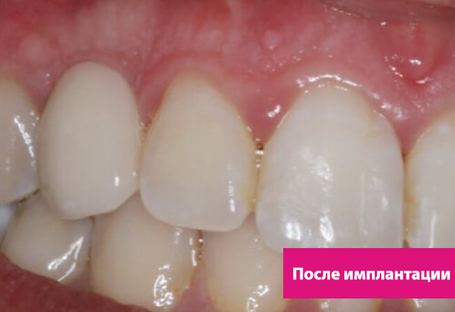 Одномоментная имплантация зубов 2.png